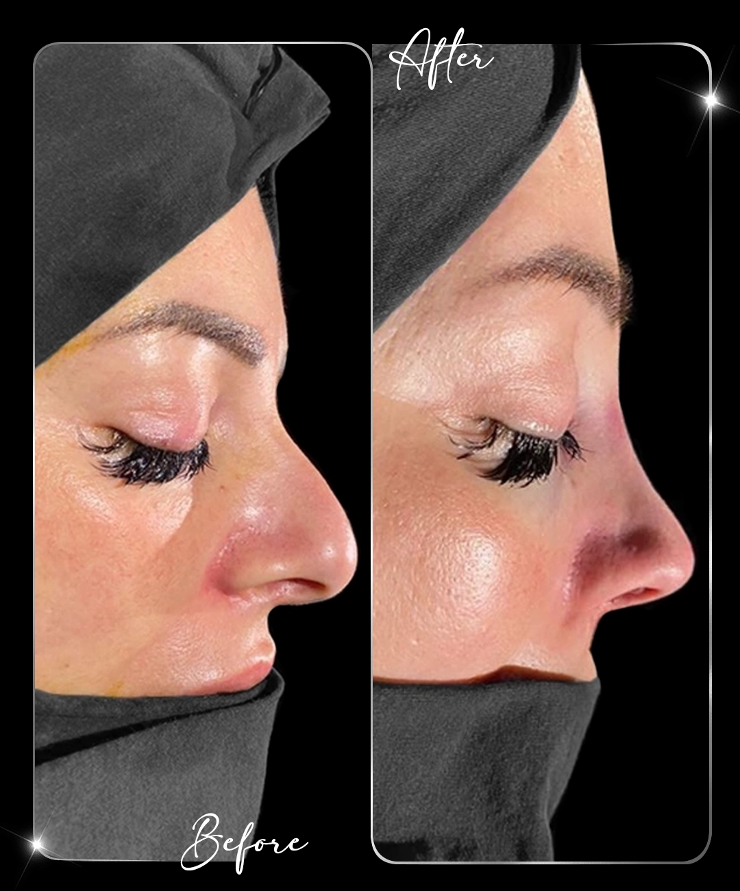 Rhinoplasty-Before-After-6