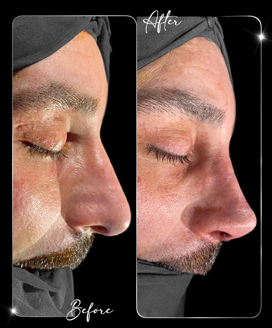 Rhinoplasty-Before-After-7