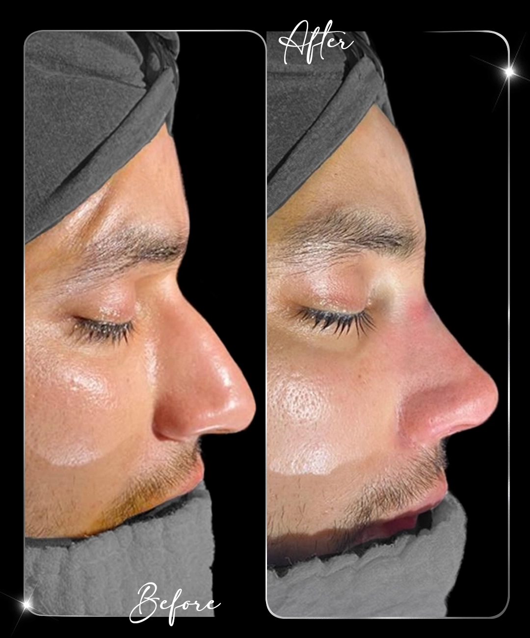 Rhinoplasty-Before-After-8