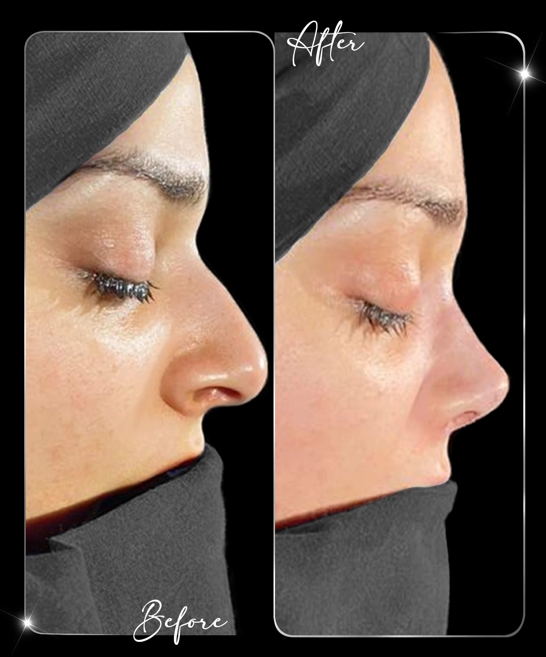 Rhinoplasty-Before-After-9