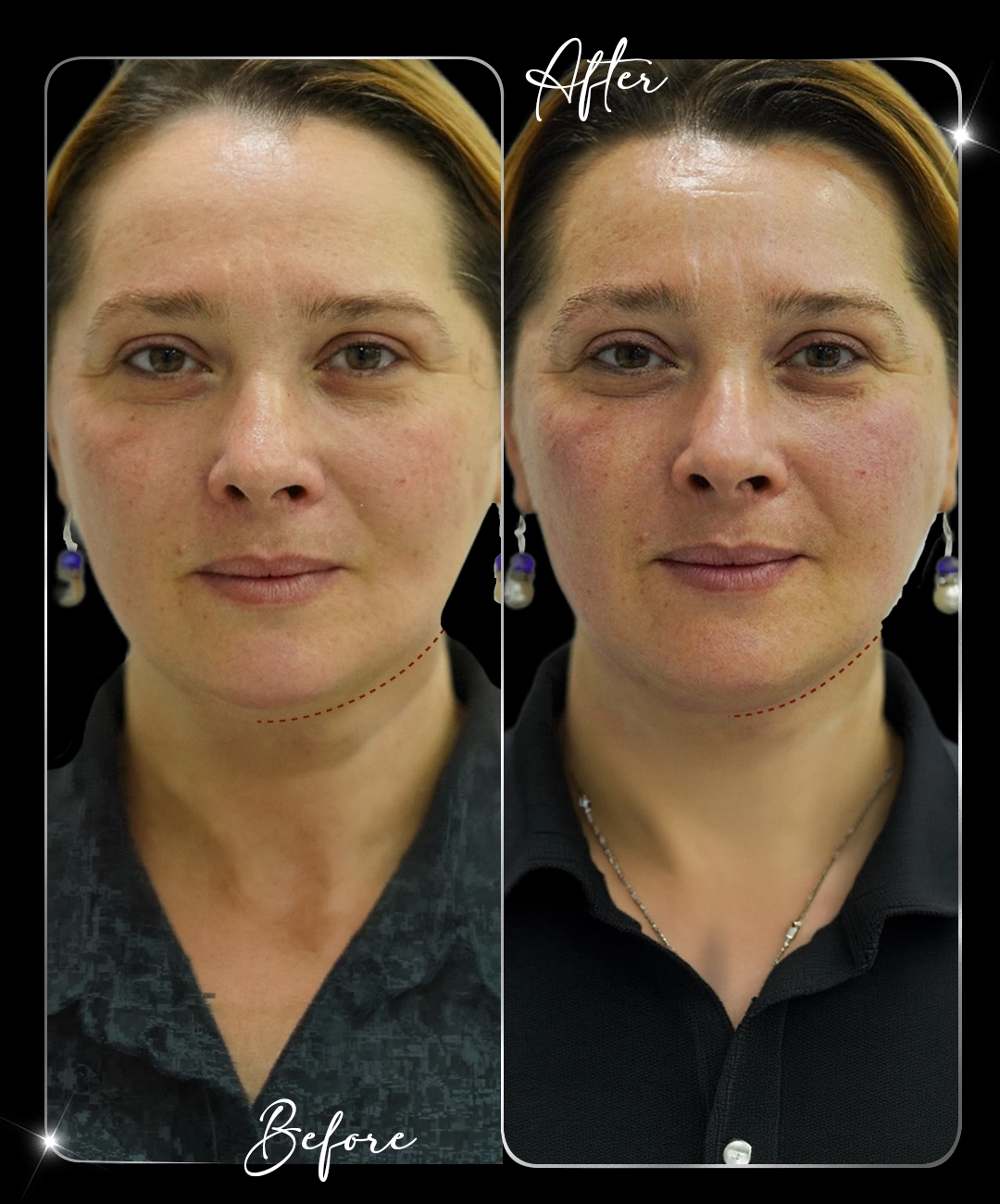 Ultraformer-Before-After-1