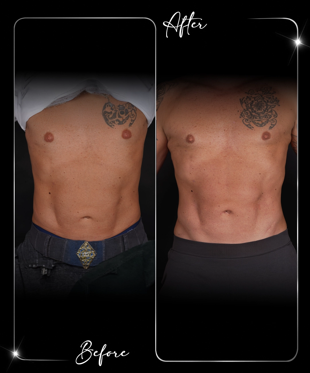 Ultraformer-Before-After-2