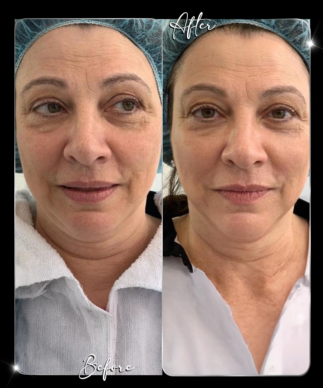 Ultraformer-Before-After-3