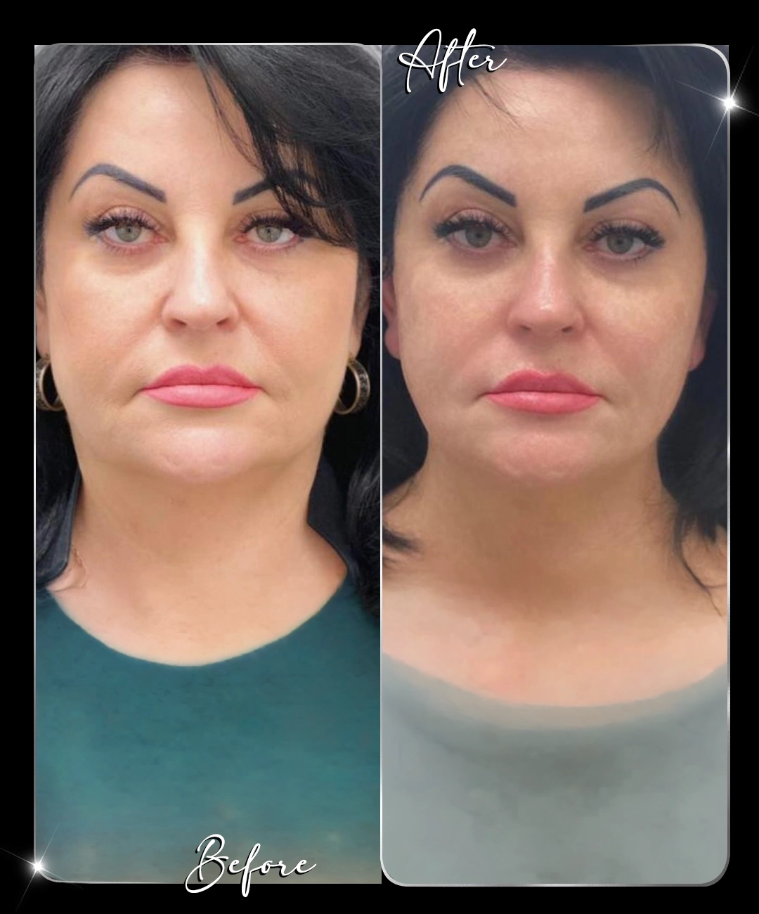 Ultraformer-Before-After-4