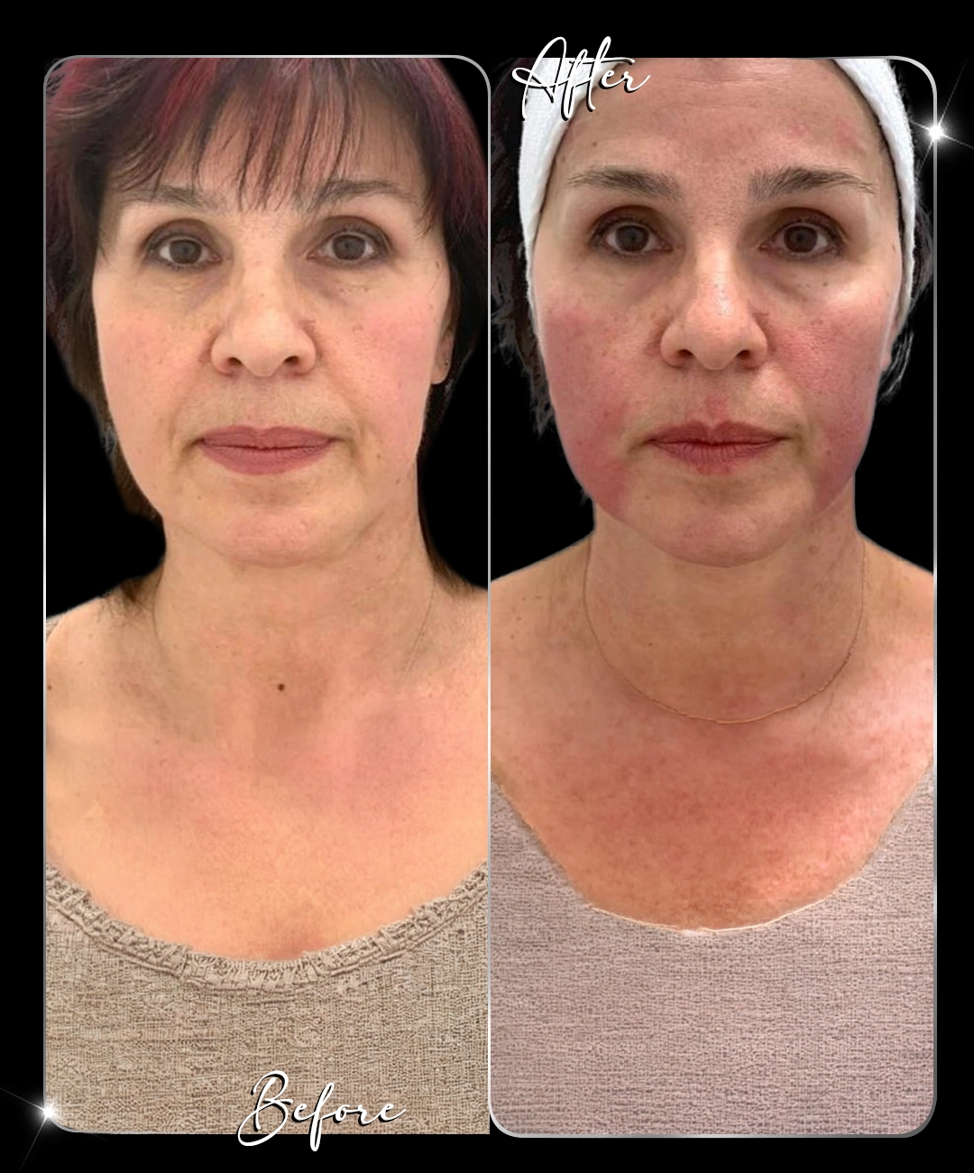Ultraformer-Before-After-5