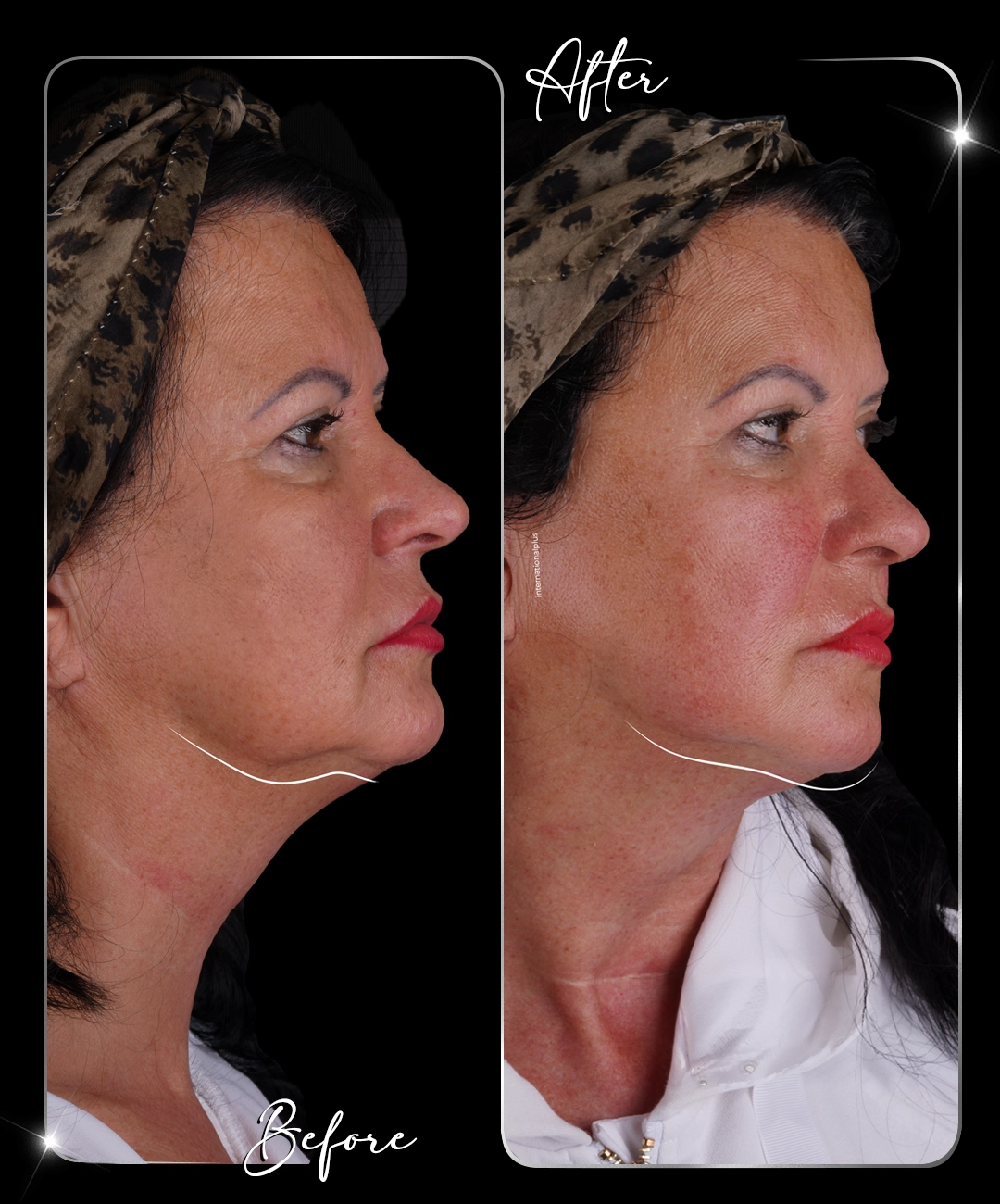 Ultraformer-Before-After-6