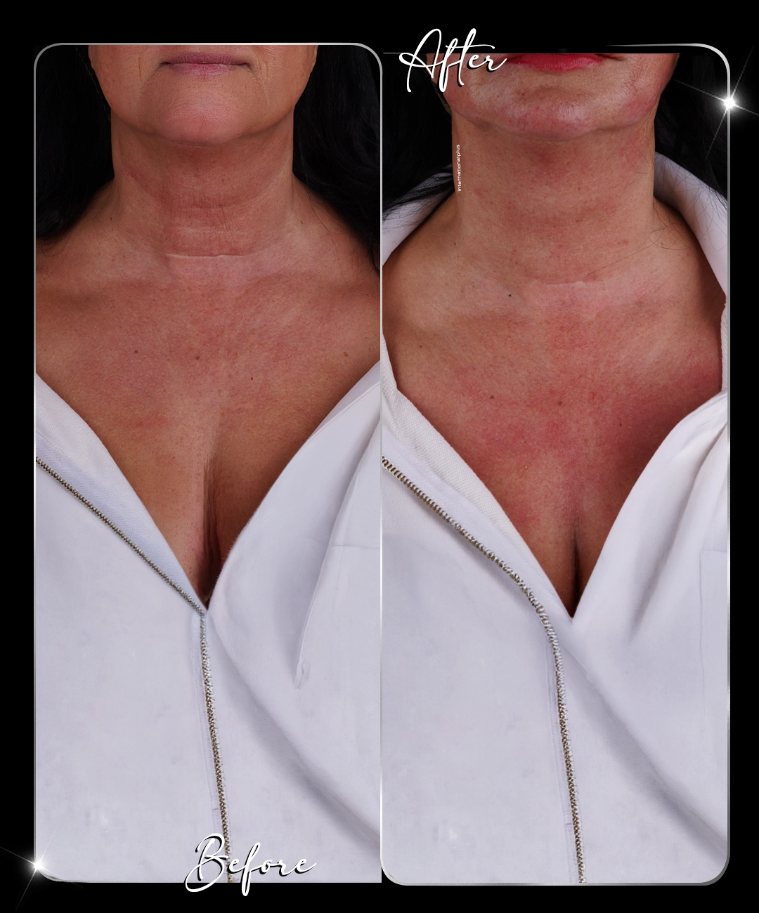 Ultraformer-Before-After-7