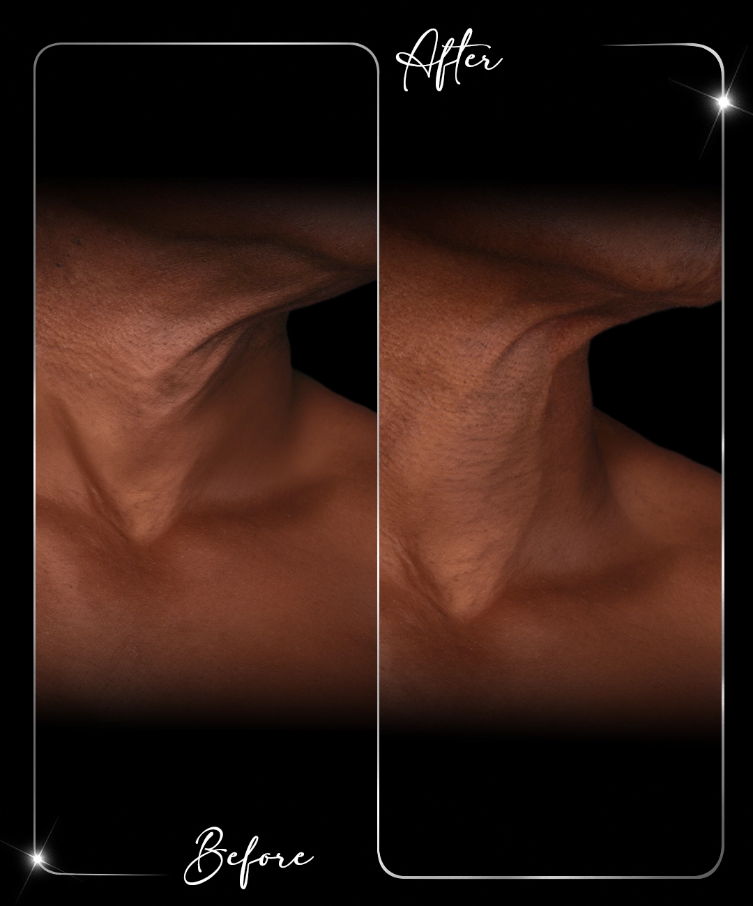 Ultraformer-Before-After-8