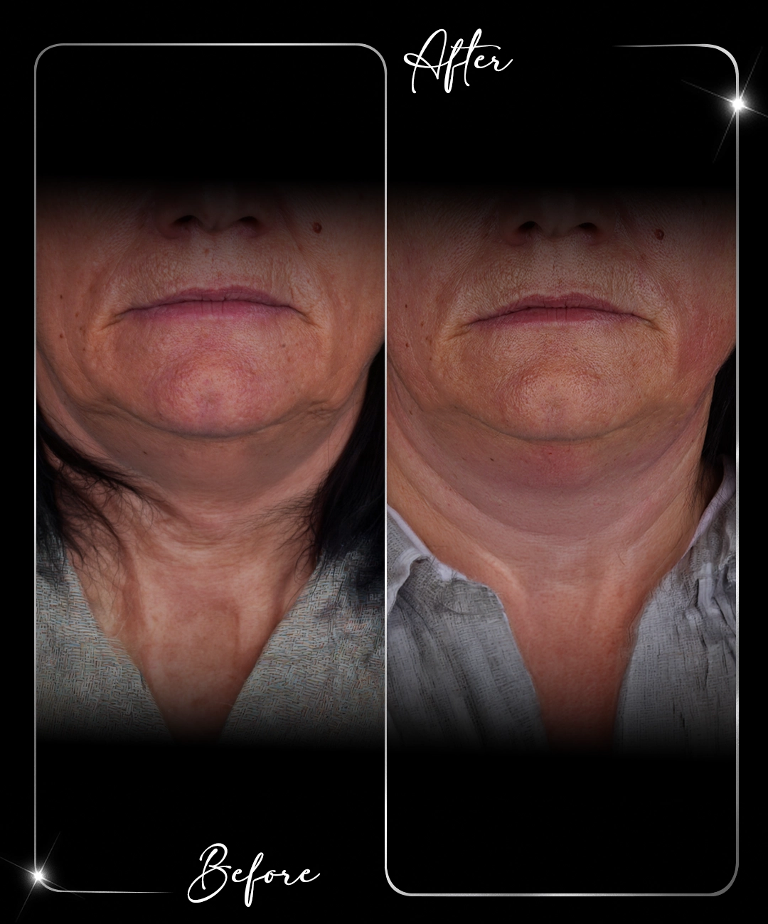Ultraformer-Before-After-9