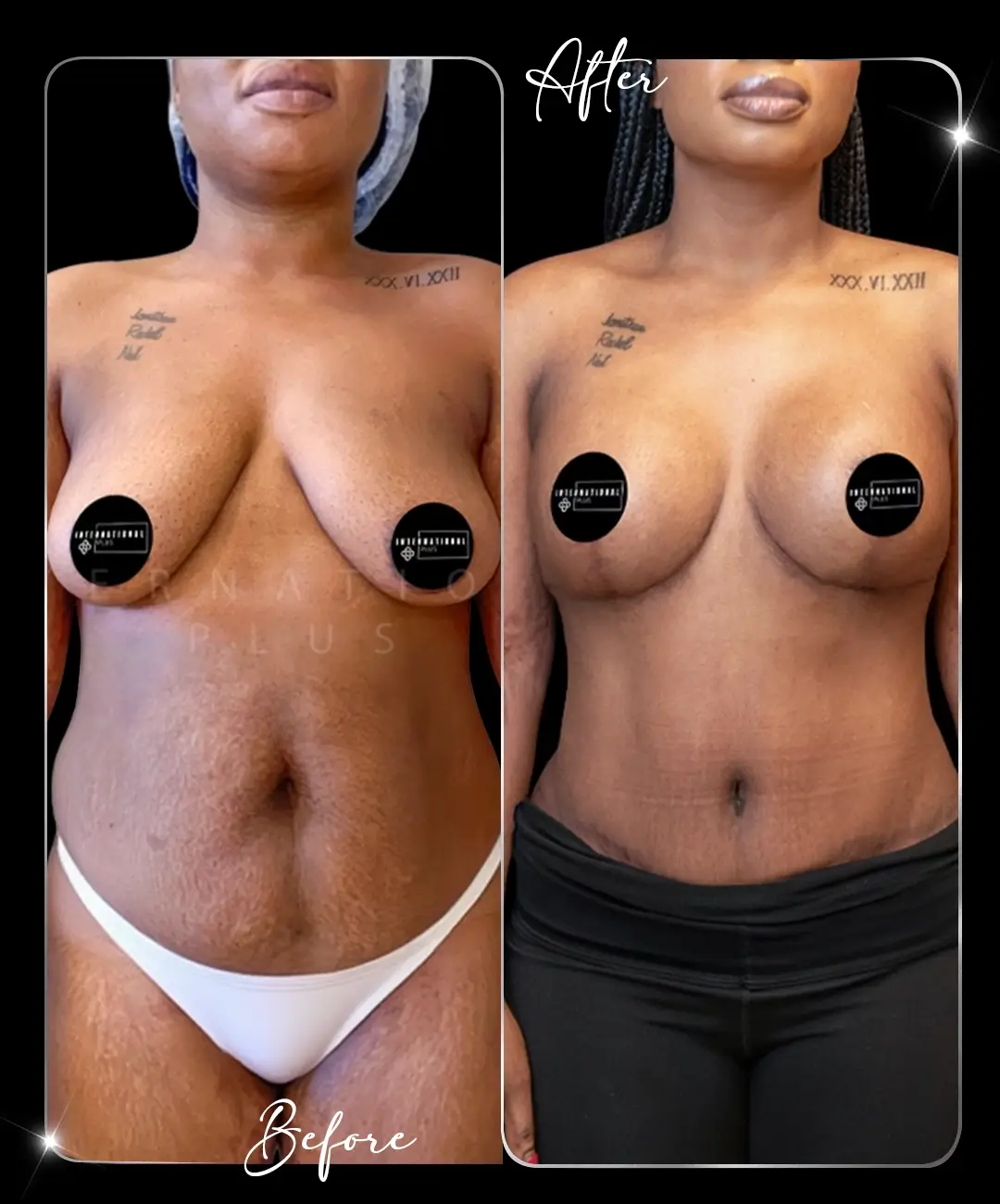 Breast-Augmentation-Before-After-1