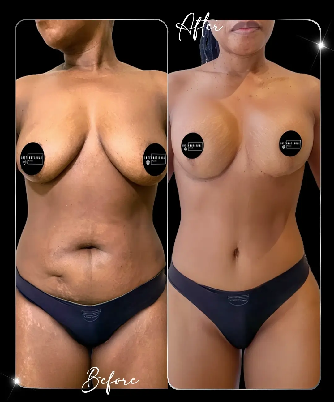 Breast-Augmentation-Before-After-2