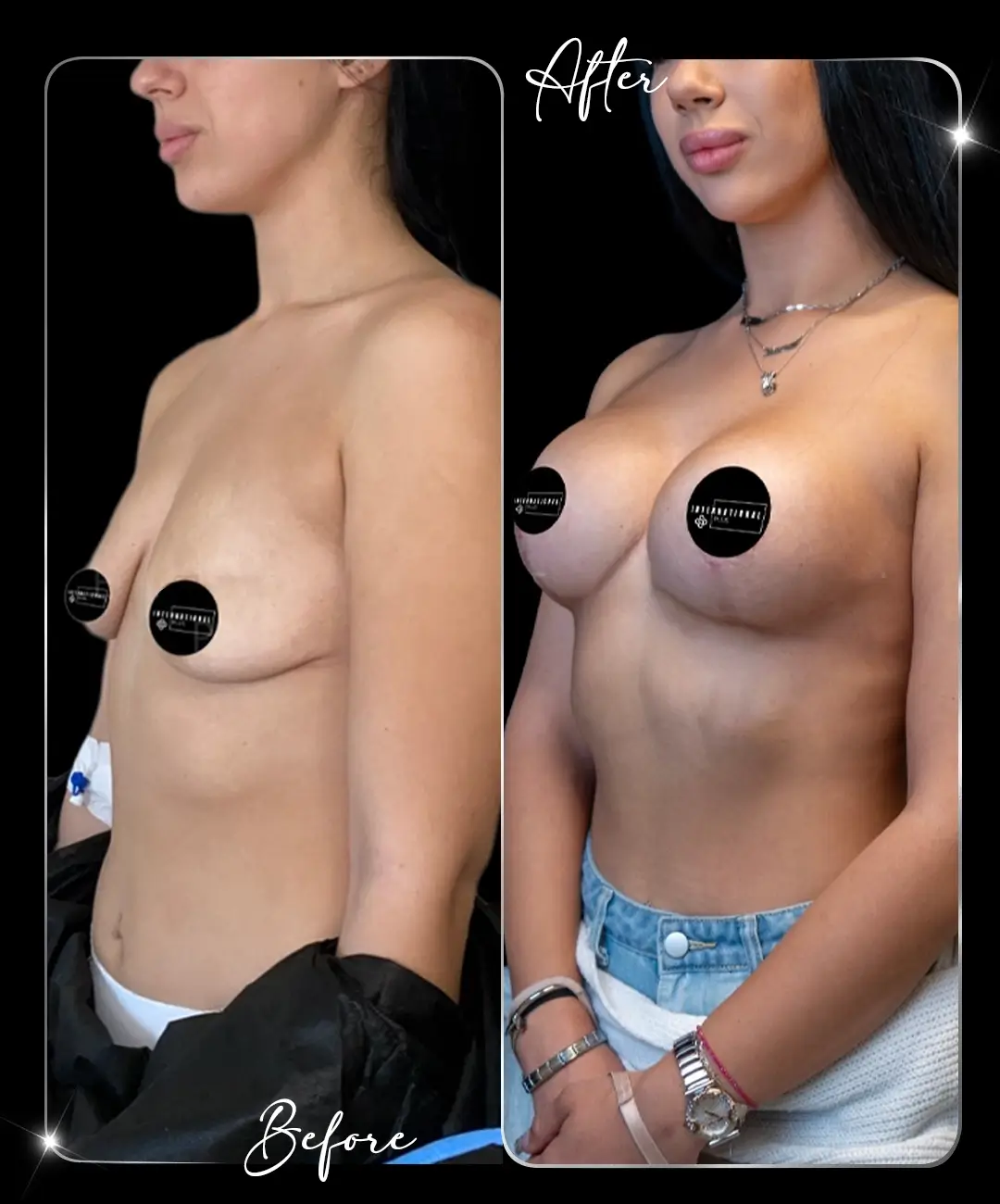 Breast-Augmentation-Before-After-4