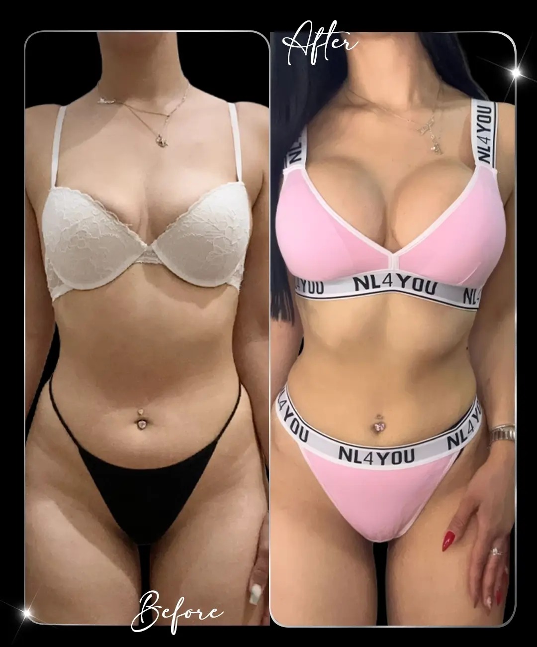 Breast-Augmentation-Before-After-5