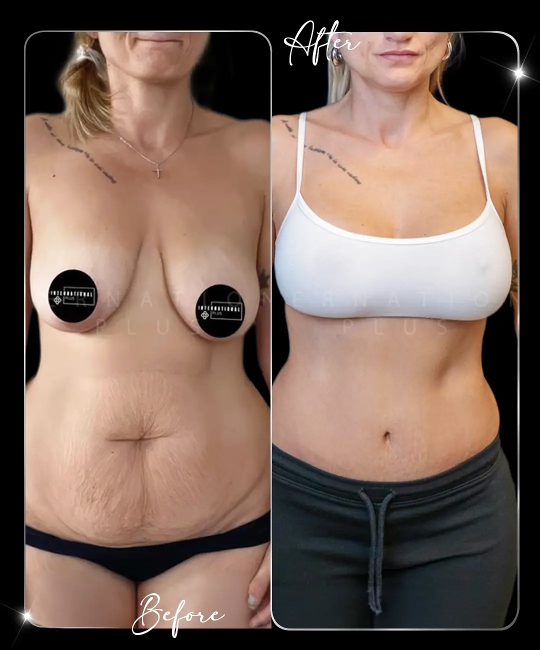 Breast-Augmentation-Before-After-6