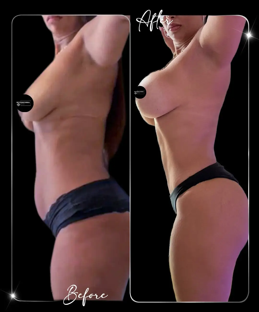 Breast-Augmentation-Before-After-7