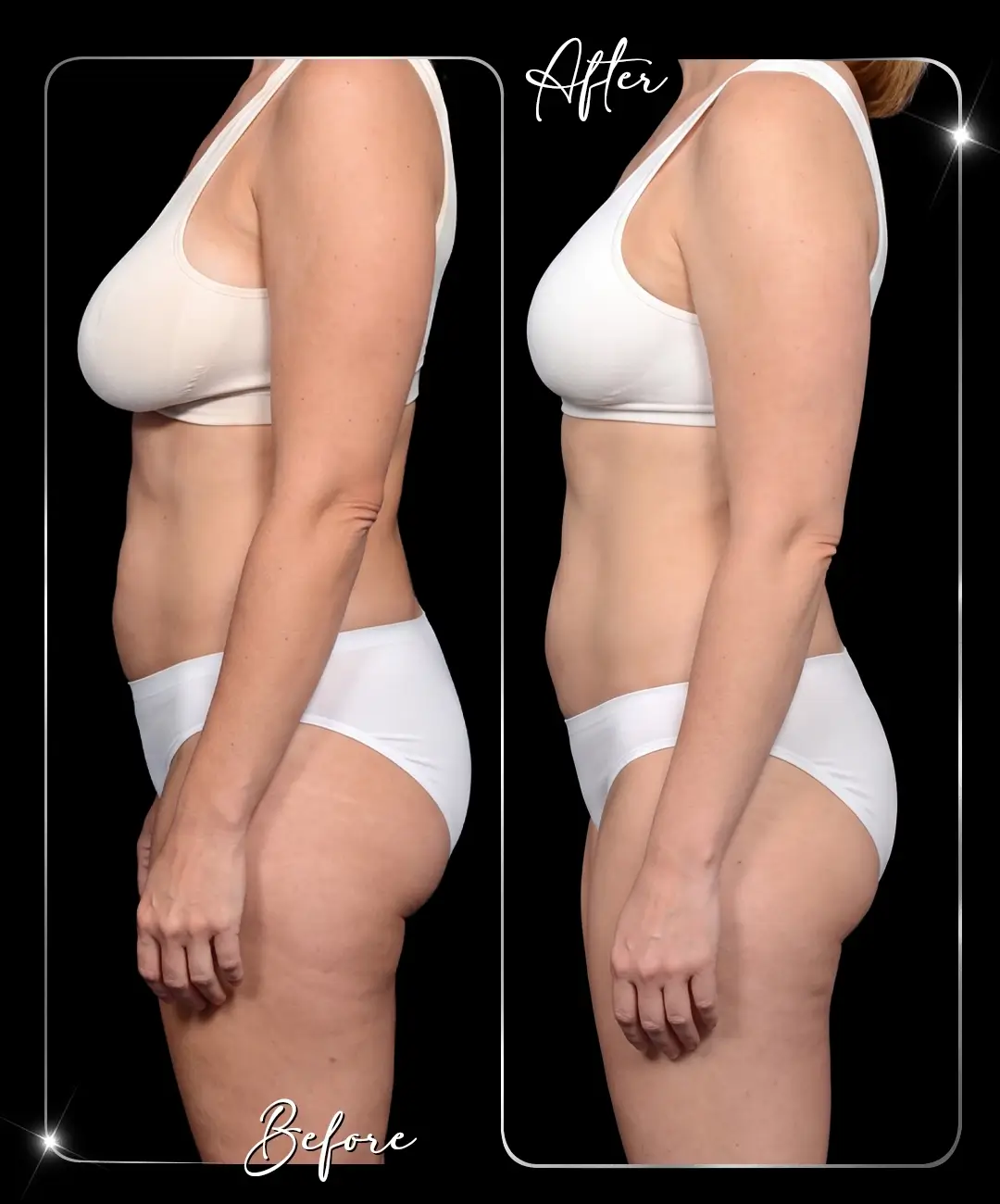 Breast-Augmentation-Before-After-8