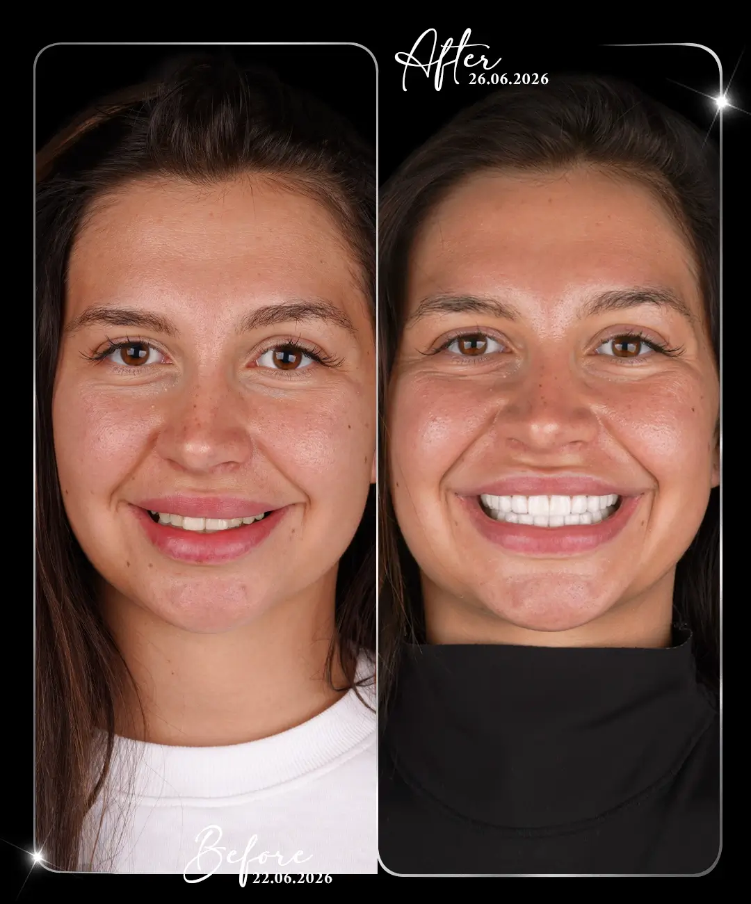 Dental-Crown-Before-After-1