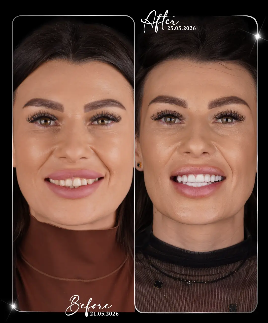 Dental-Crown-Before-After-2