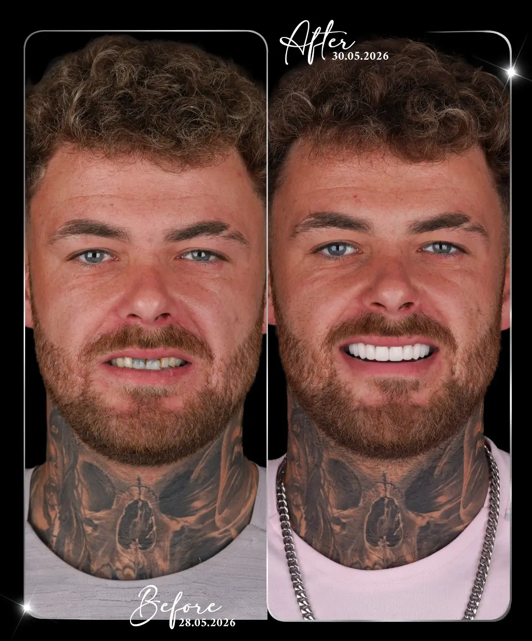 Dental-Crown-Before-After-3