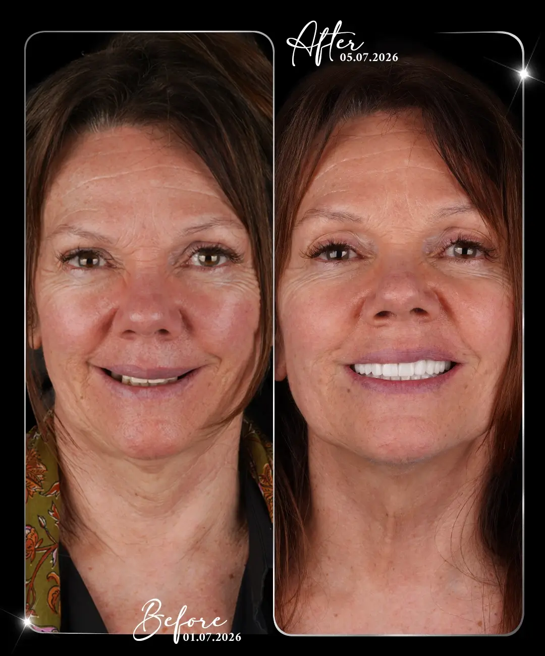 Dental-Crown-Before-After-4