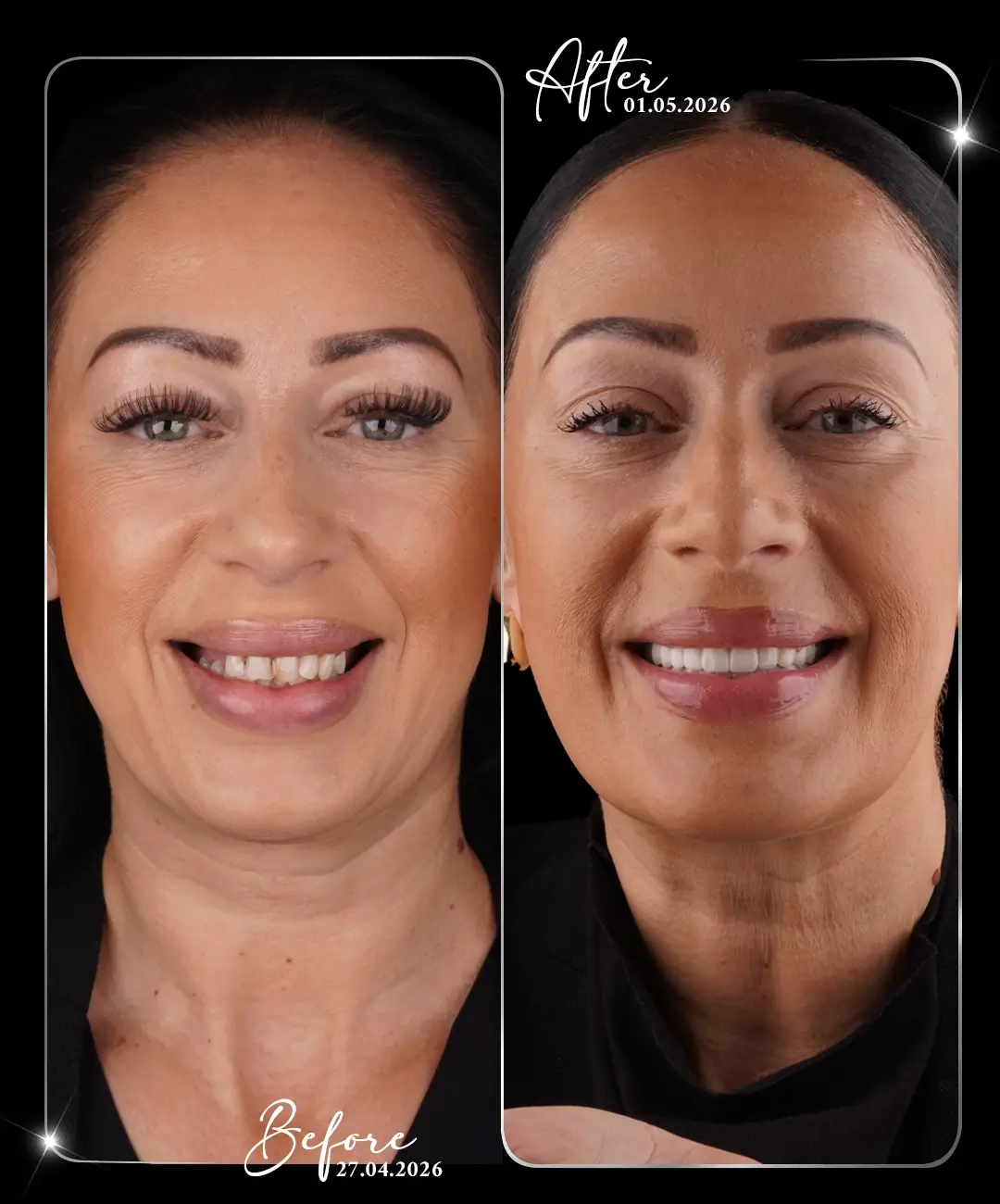 Dental-Crown-Before-After-5
