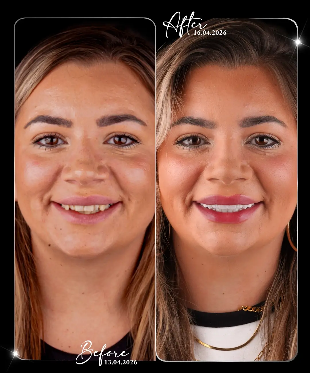 Dental-Crown-Before-After-6