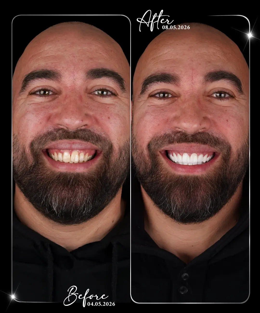 Dental-Crown-Before-After-7