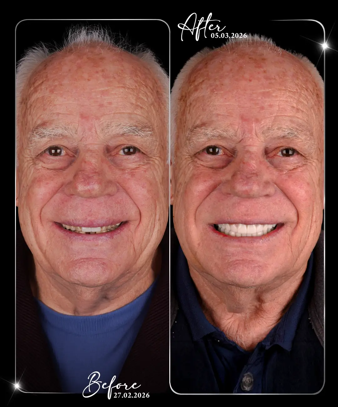 Dental-Crown-Before-After-8