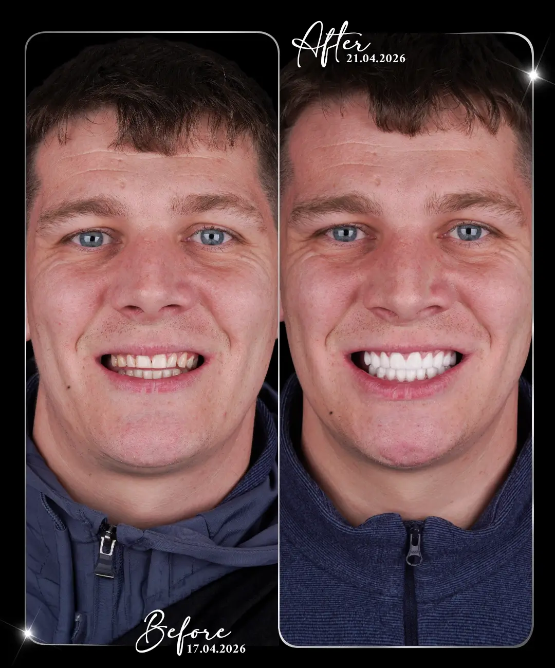 Dental-Crown-Before-After-9