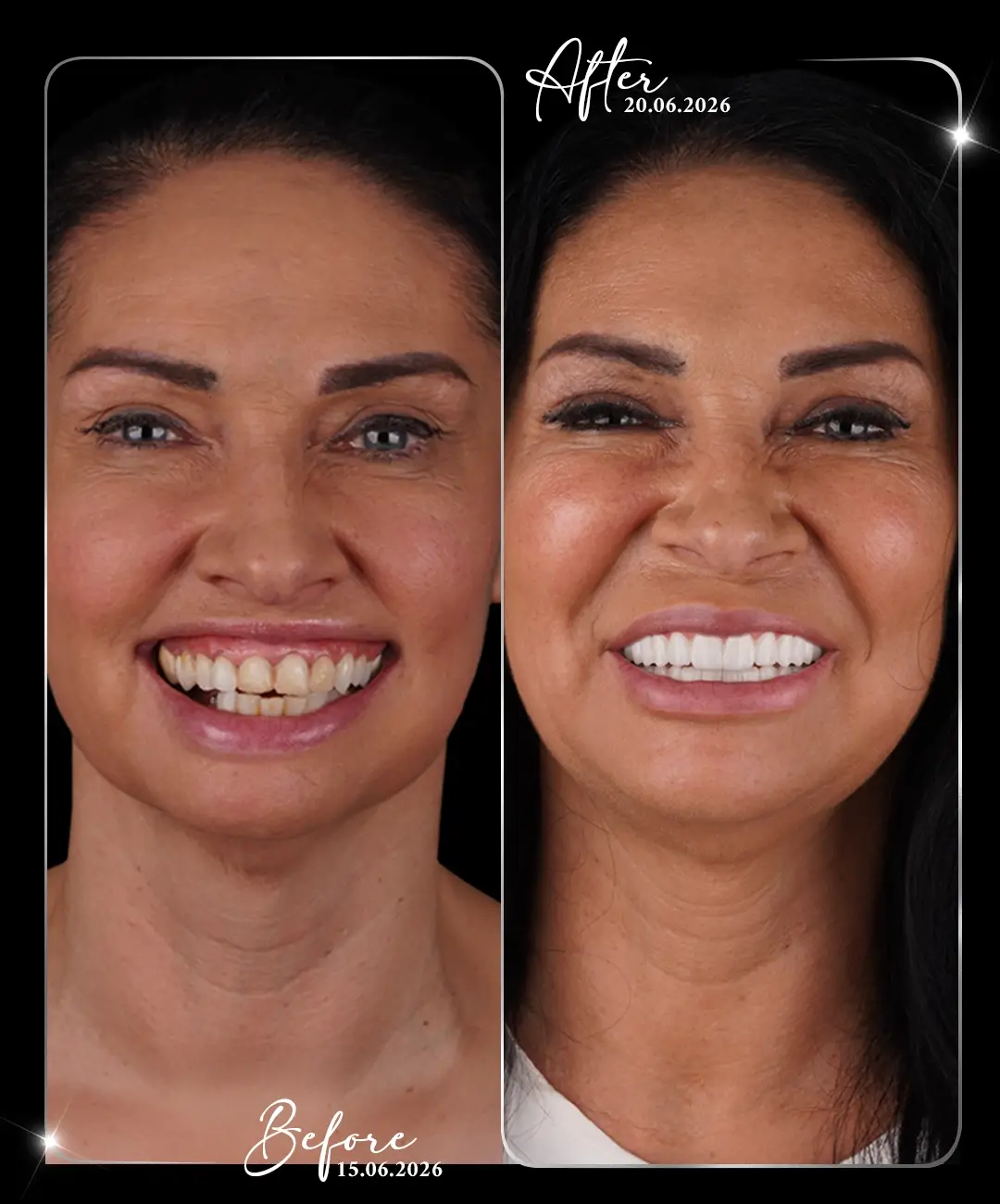 Dental-Implant-Before-After-1