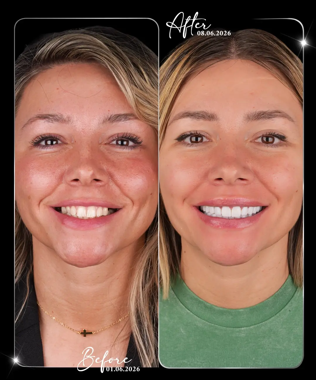 Dental-Implant-Before-After-2