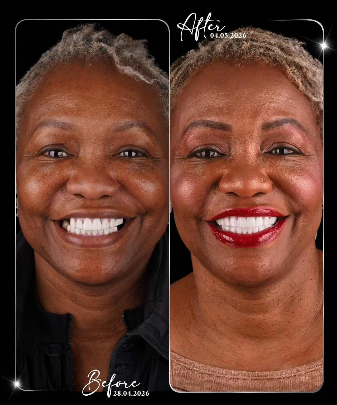 Dental-Implant-Before-After-3