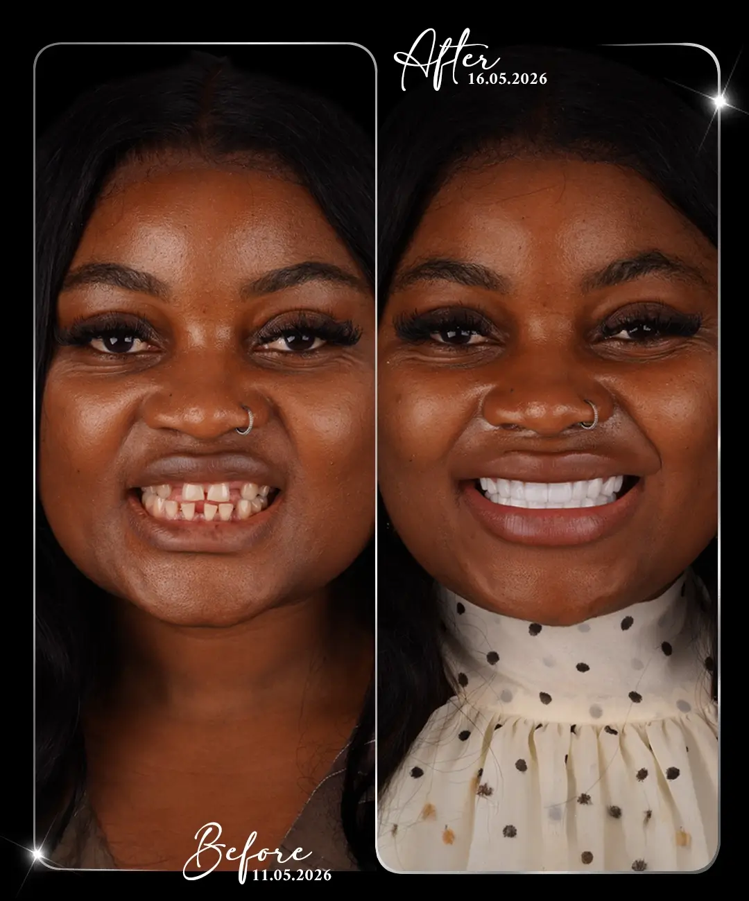 Dental-Implant-Before-After-4