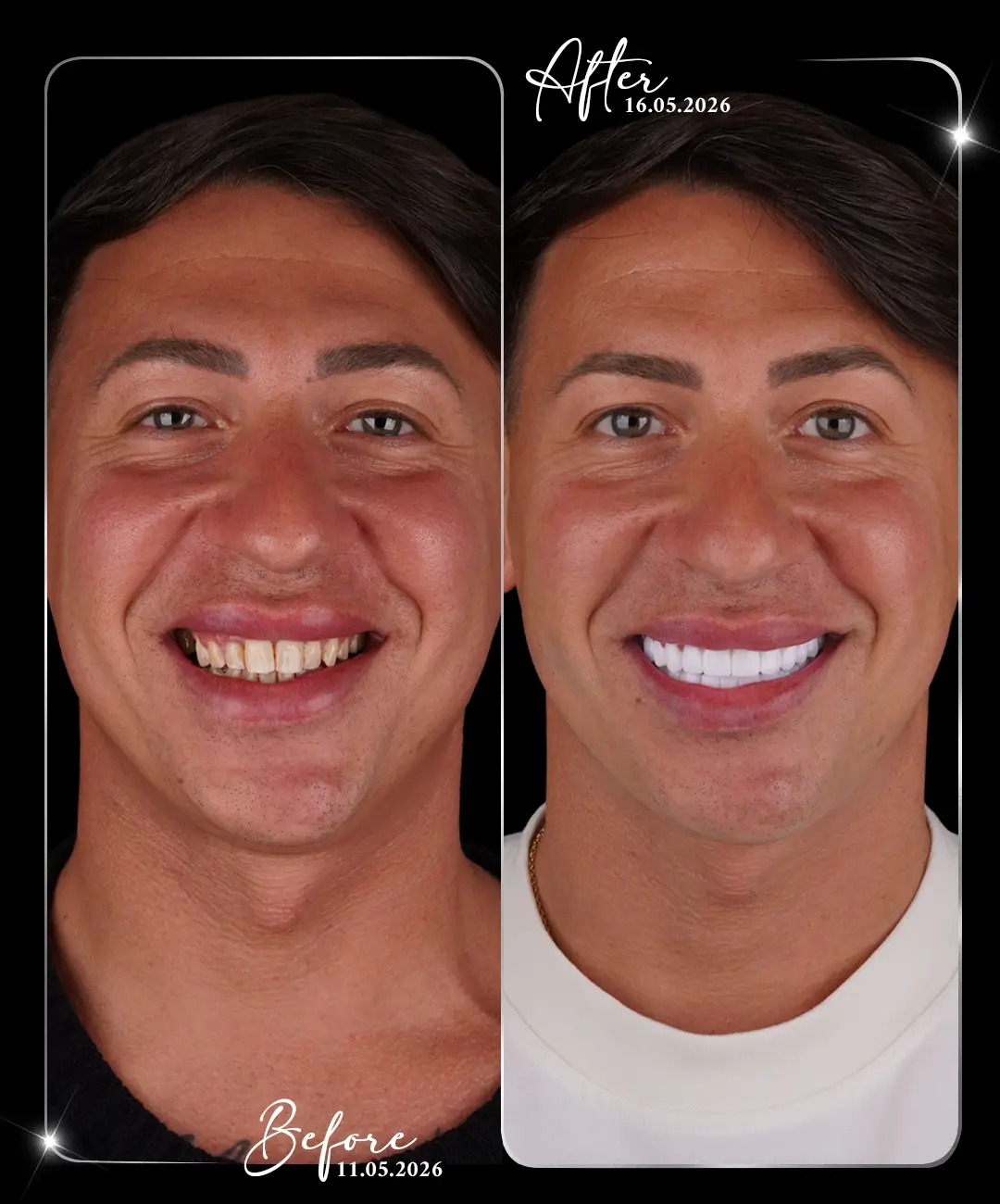 Dental-Implant-Before-After-5