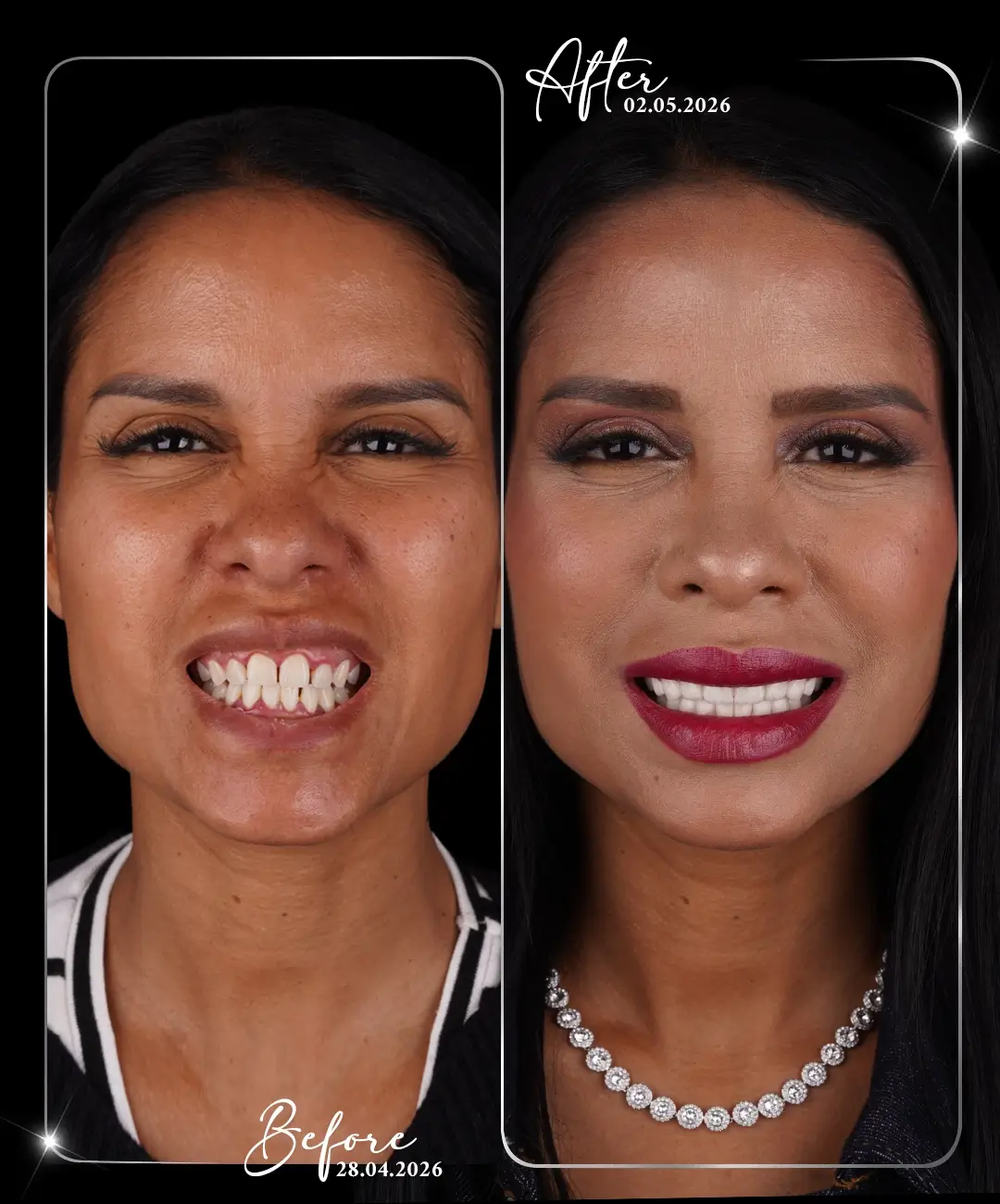 Dental-Implant-Before-After-6