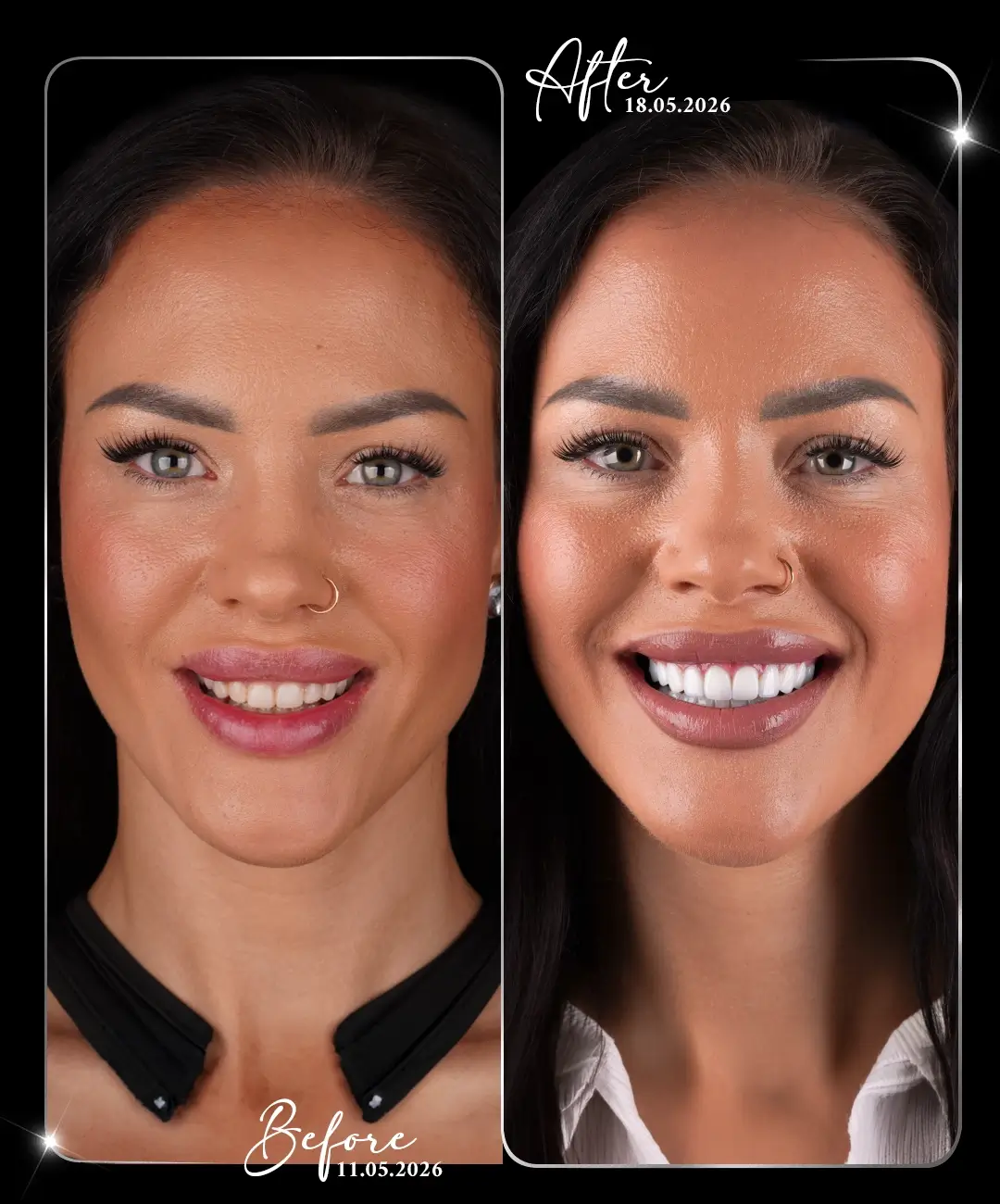 Dental-Implant-Before-After-7