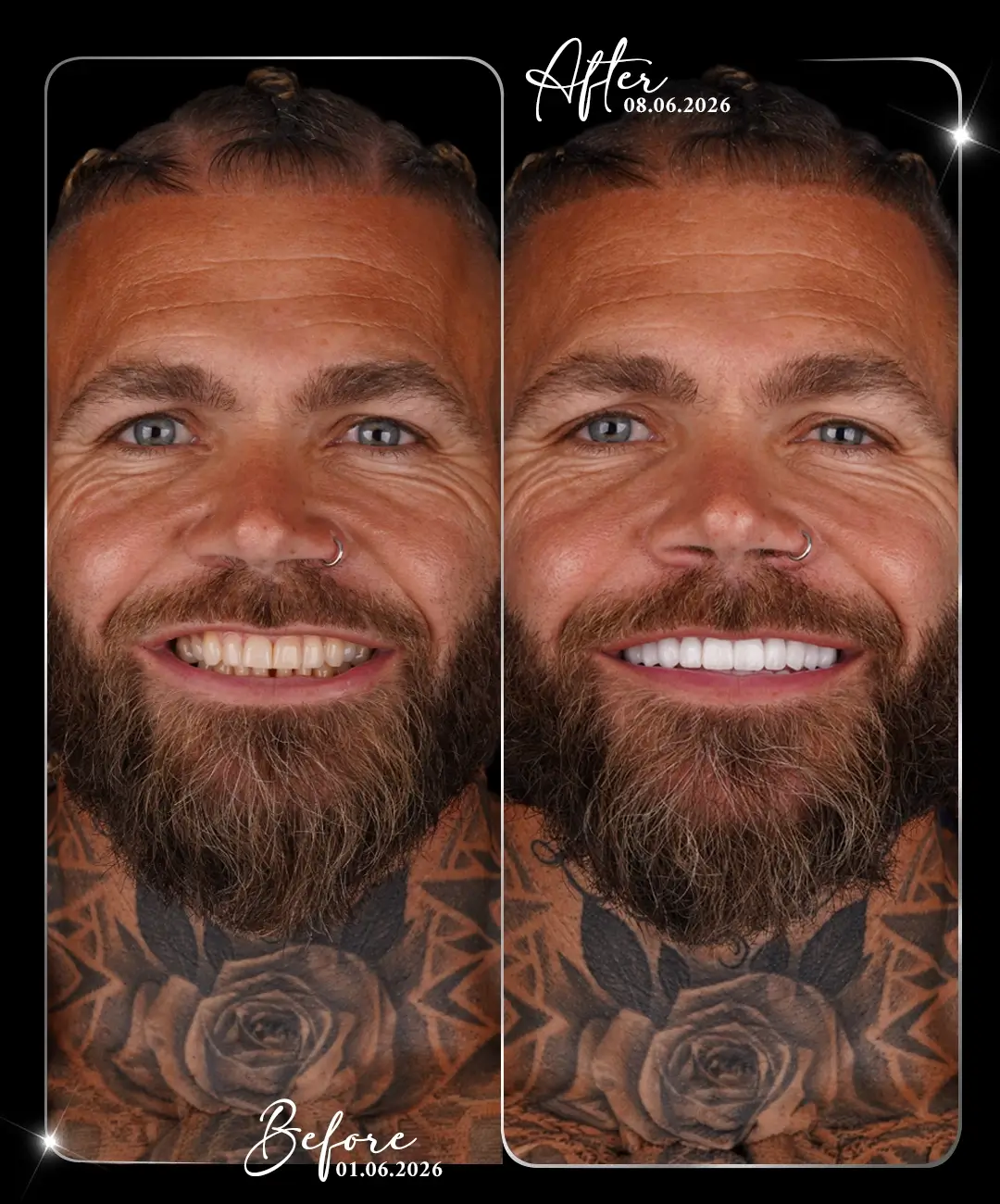 Dental-Implant-Before-After-8