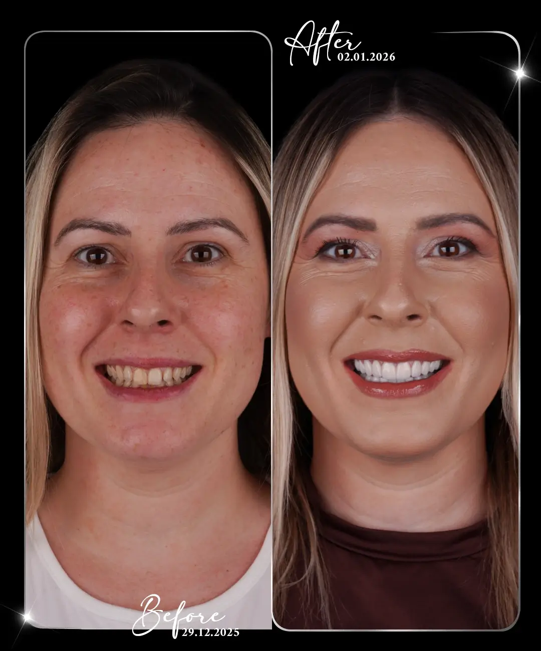 Digital-Smile-Design-Before-After-1