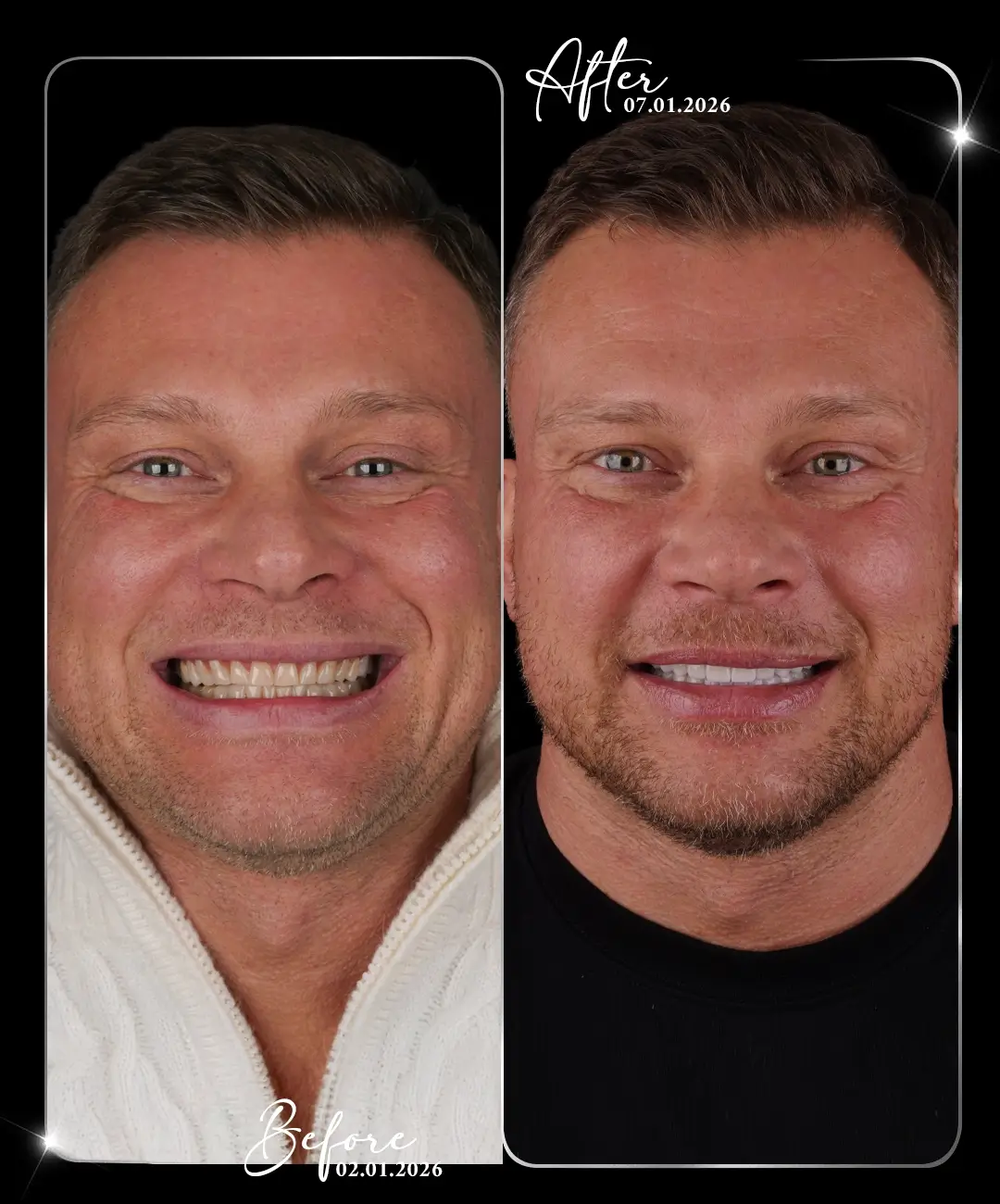 Digital-Smile-Design-Before-After-2