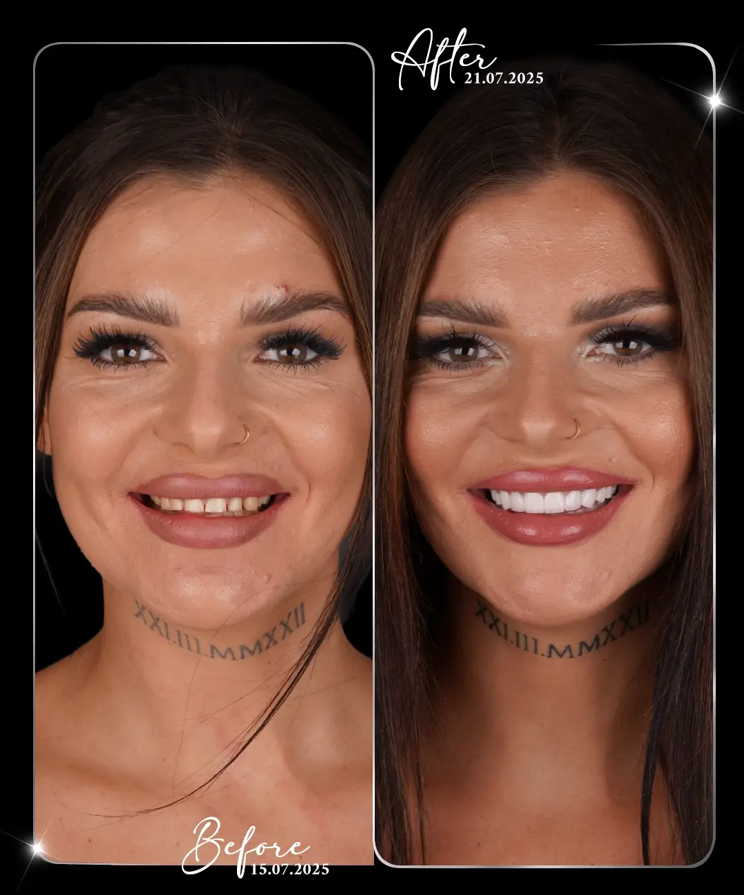 Digital-Smile-Design-Before-After-3