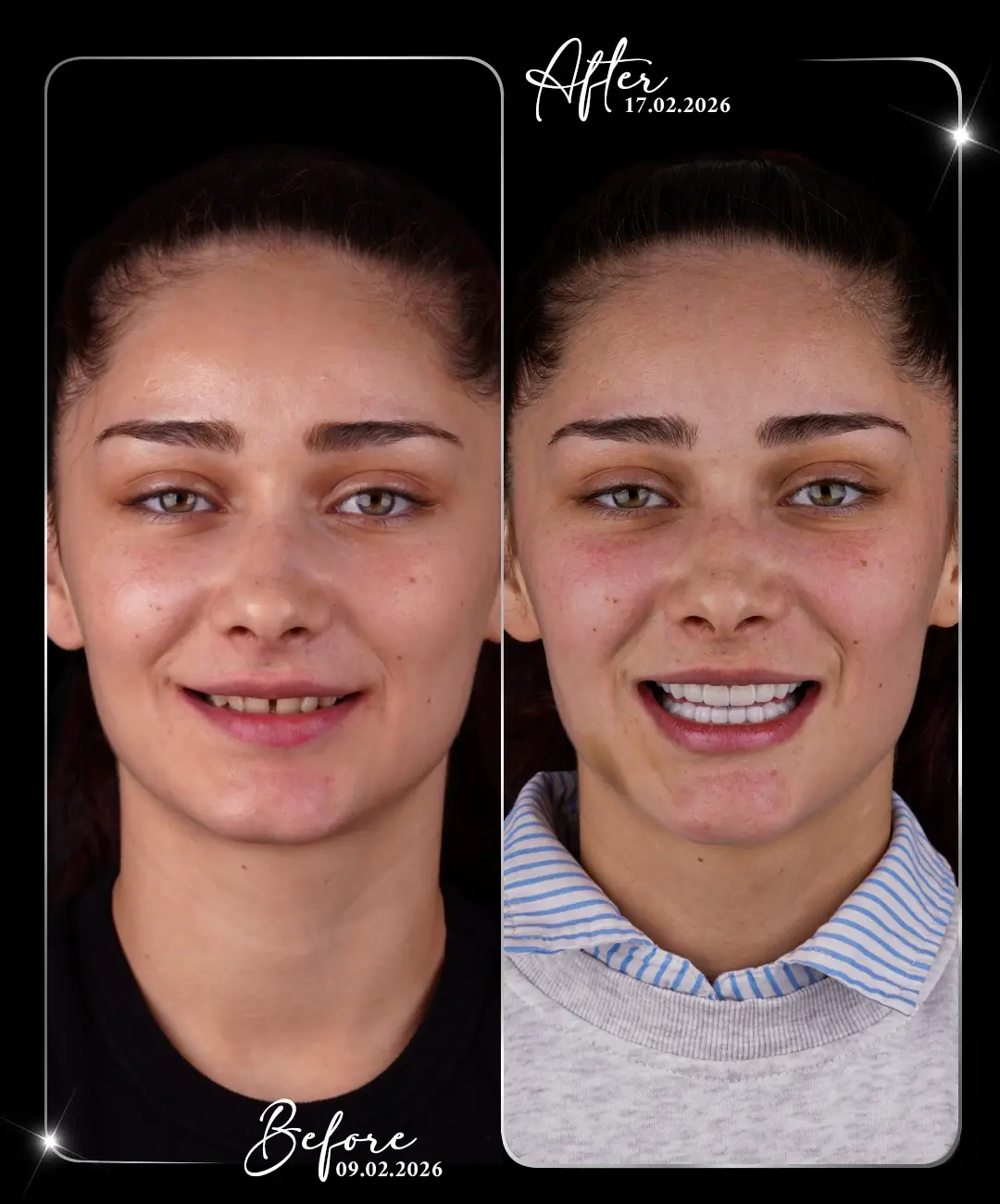 Digital-Smile-Design-Before-After-4