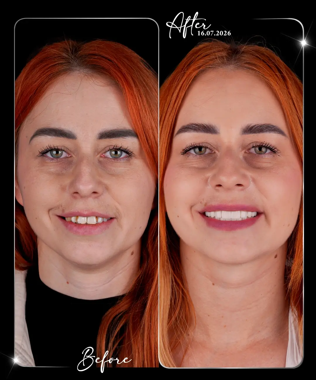 Digital-Smile-Design-Before-After-5