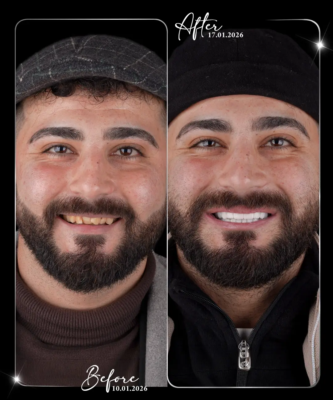 Digital-Smile-Design-Before-After-6