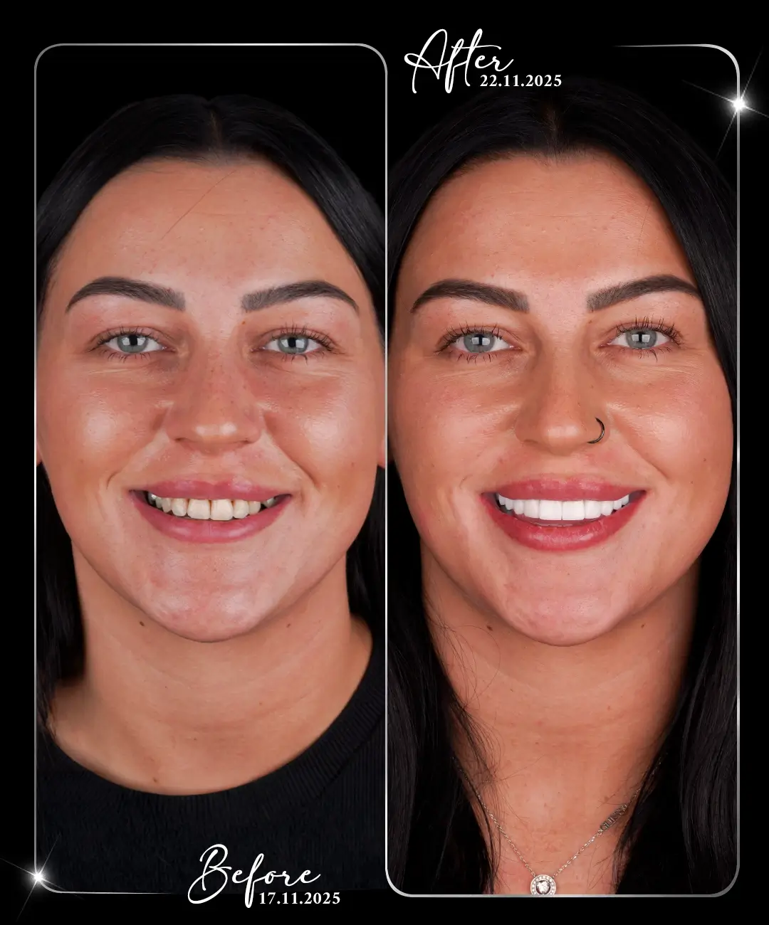 Digital-Smile-Design-Before-After-7