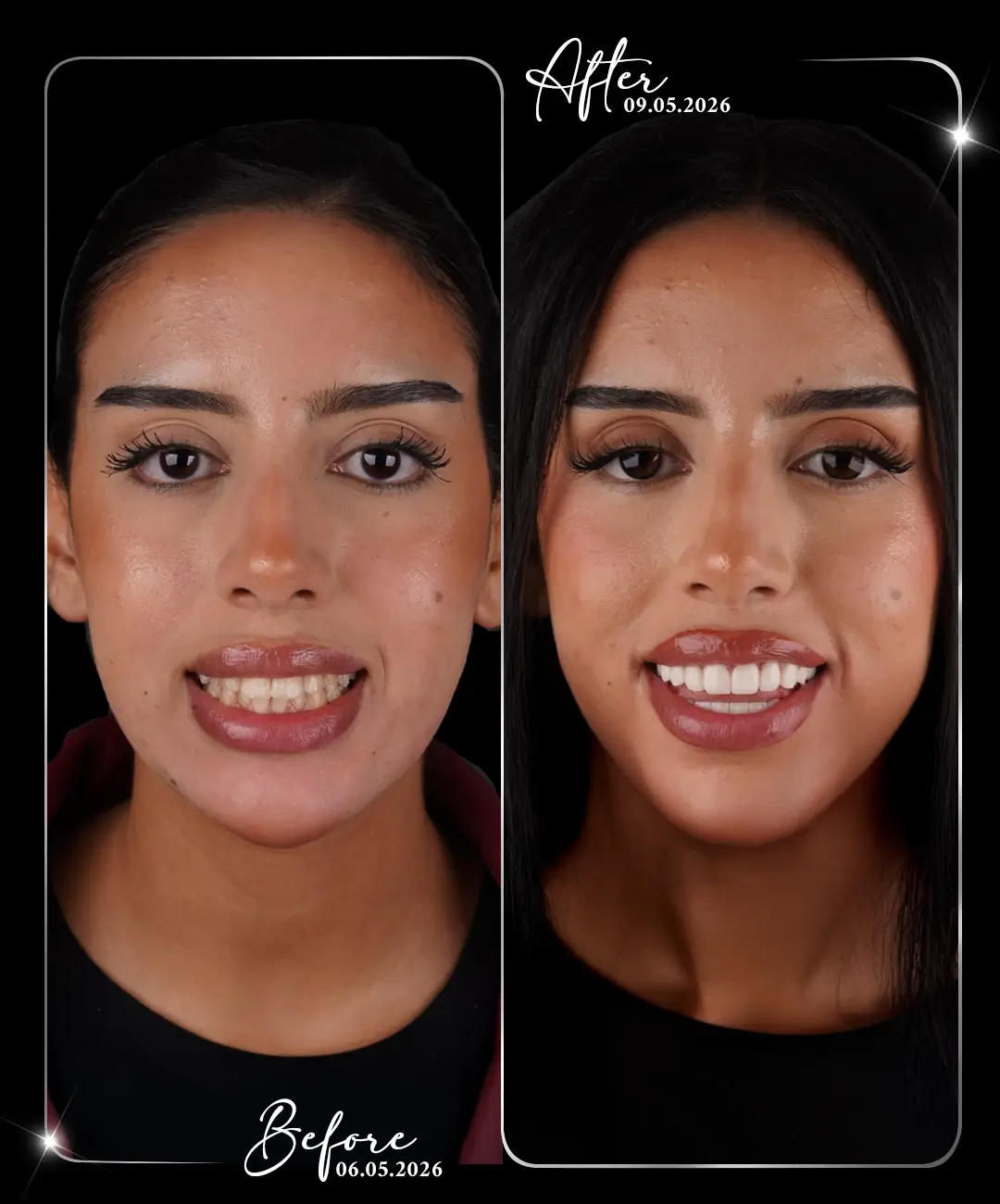 Digital-Smile-Design-Before-After-8