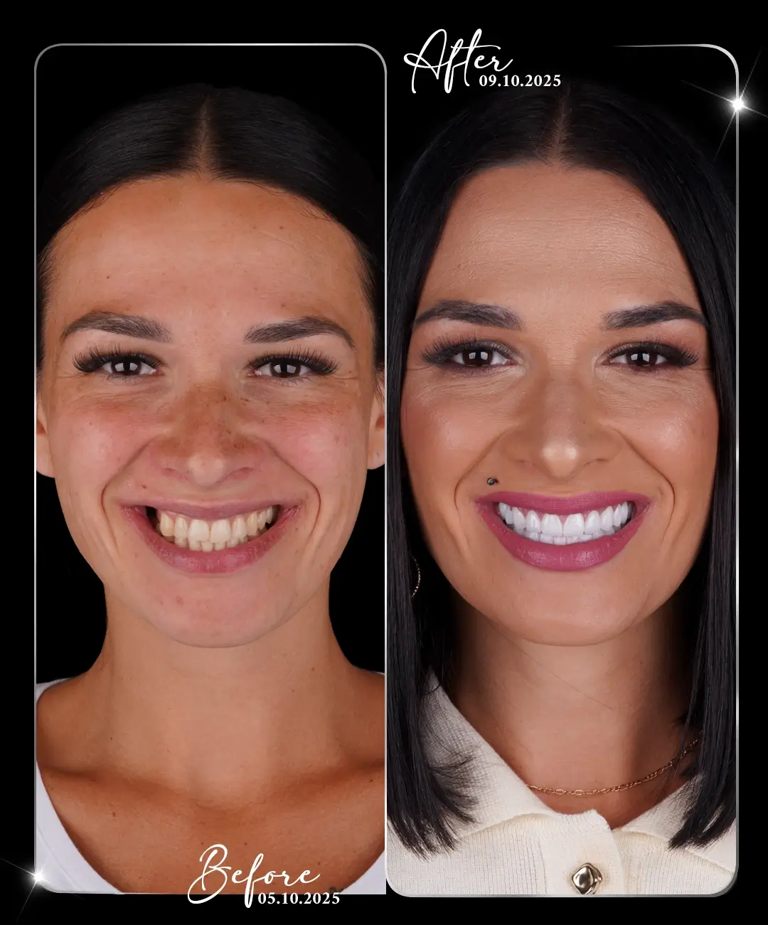 Digital-Smile-Design-Before-After-9