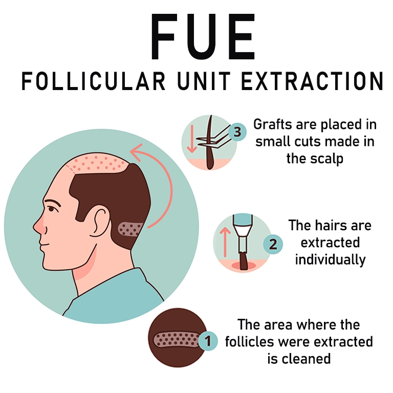 FUE Follicular Unit Extraction technique