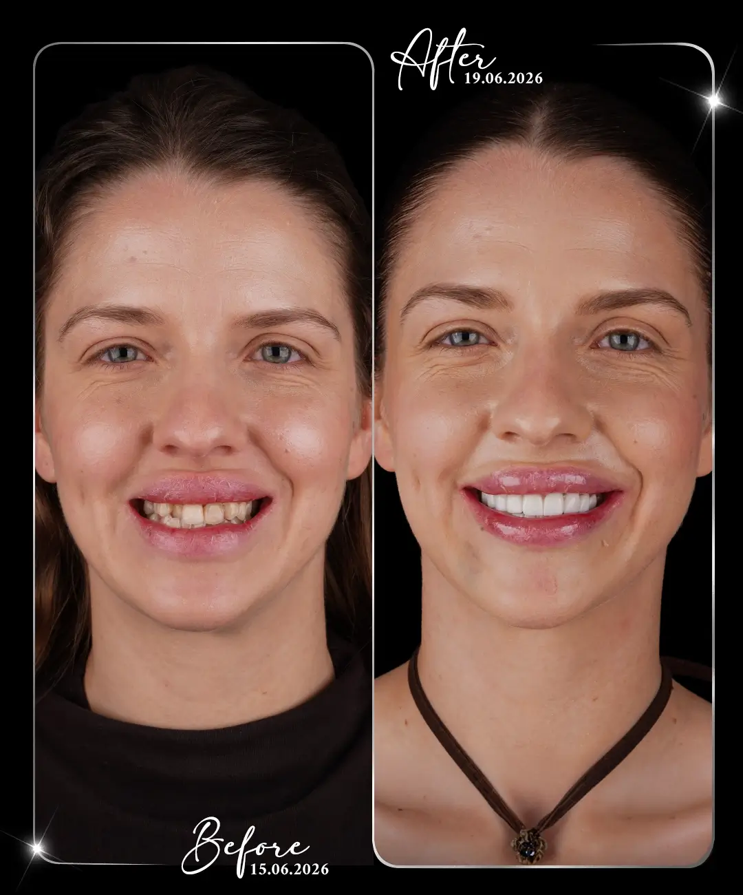 Hollywood-Smile-Before-After-1