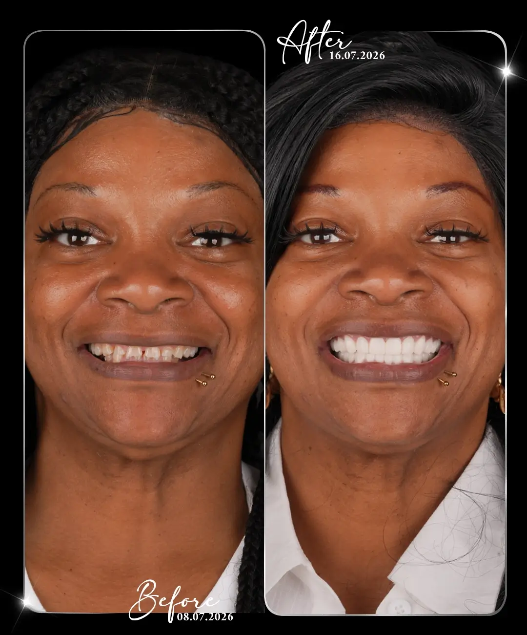Hollywood-Smile-Before-After-2