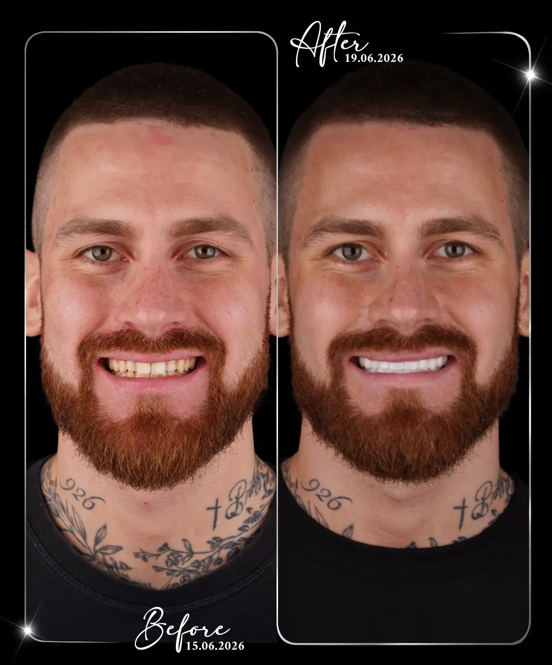 Hollywood-Smile-Before-After-3